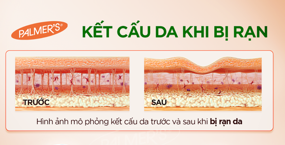 Làm Thế Nào Để Loại Bỏ Vết Rạn Da