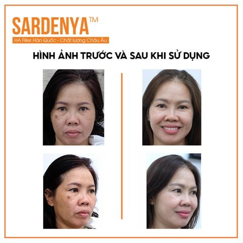HÌNH ẢNH SAU KHI SỬ DỤNG SẢN PHẨM SARDENYA™