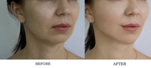 Sử dụng filler SARDENYA trẻ hóa vùng mặt