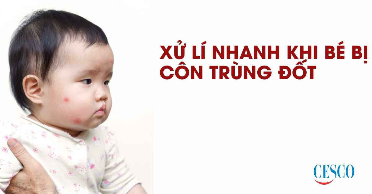 Xử lí nhanh cho bé bị côn trùng đốt