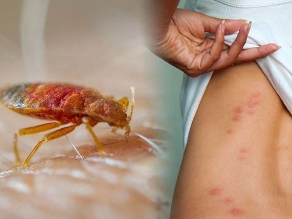hình ảnh vết rệp giường cắn đốt không xử lí đúng cách bị sưng, ngứa