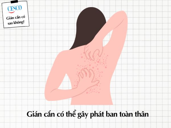gián có cắn không, gián cắn có sao không, bị gián cắn gây phát ban toàn thân