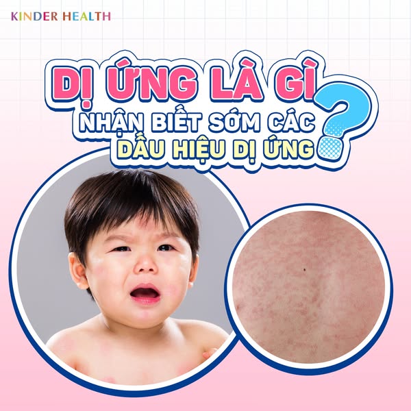 DỊ ỨNG LÀ GÌ, NHẬN BIẾT SỚM CÁC DẤU HIỆU DỊ ỨNG