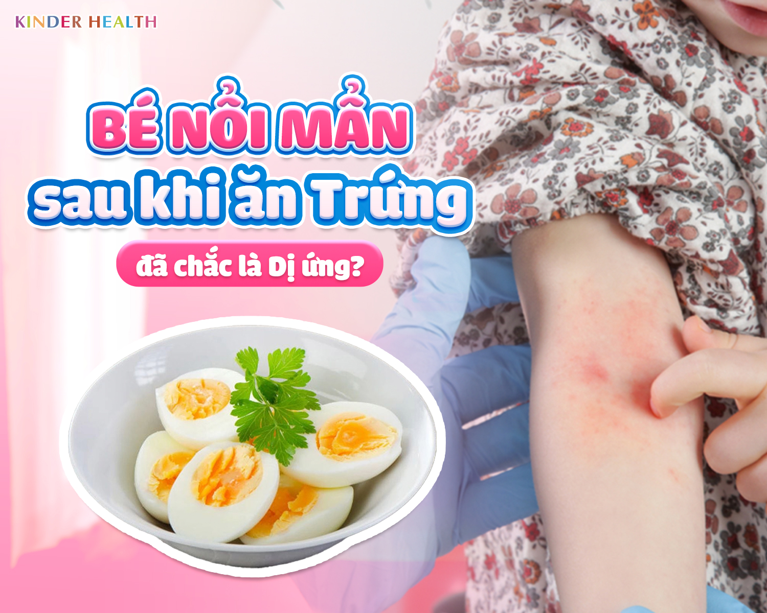 BÉ NỔI MẨN SAU KHI ĂN TRỨNG – ĐÃ CHẮC LÀ DỊ ỨNG?