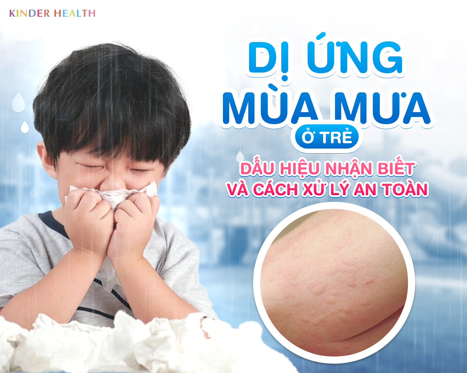 DỊ ỨNG MÙA MƯA Ở TRẺ: DẤU HIỆU NHẬN BIẾT VÀ CÁCH XỬ LÝ AN TOÀN