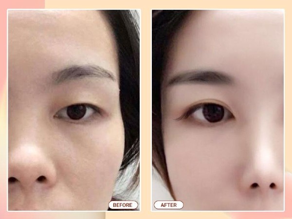EYELID SURGERY – THE REMOVAL OF IMPERFECT POINTS AROUND THE EYE AREA