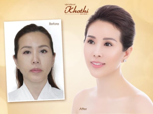 Cấy chỉ collagen da mặt là gì? 8+ thông tin quan trọng nhất