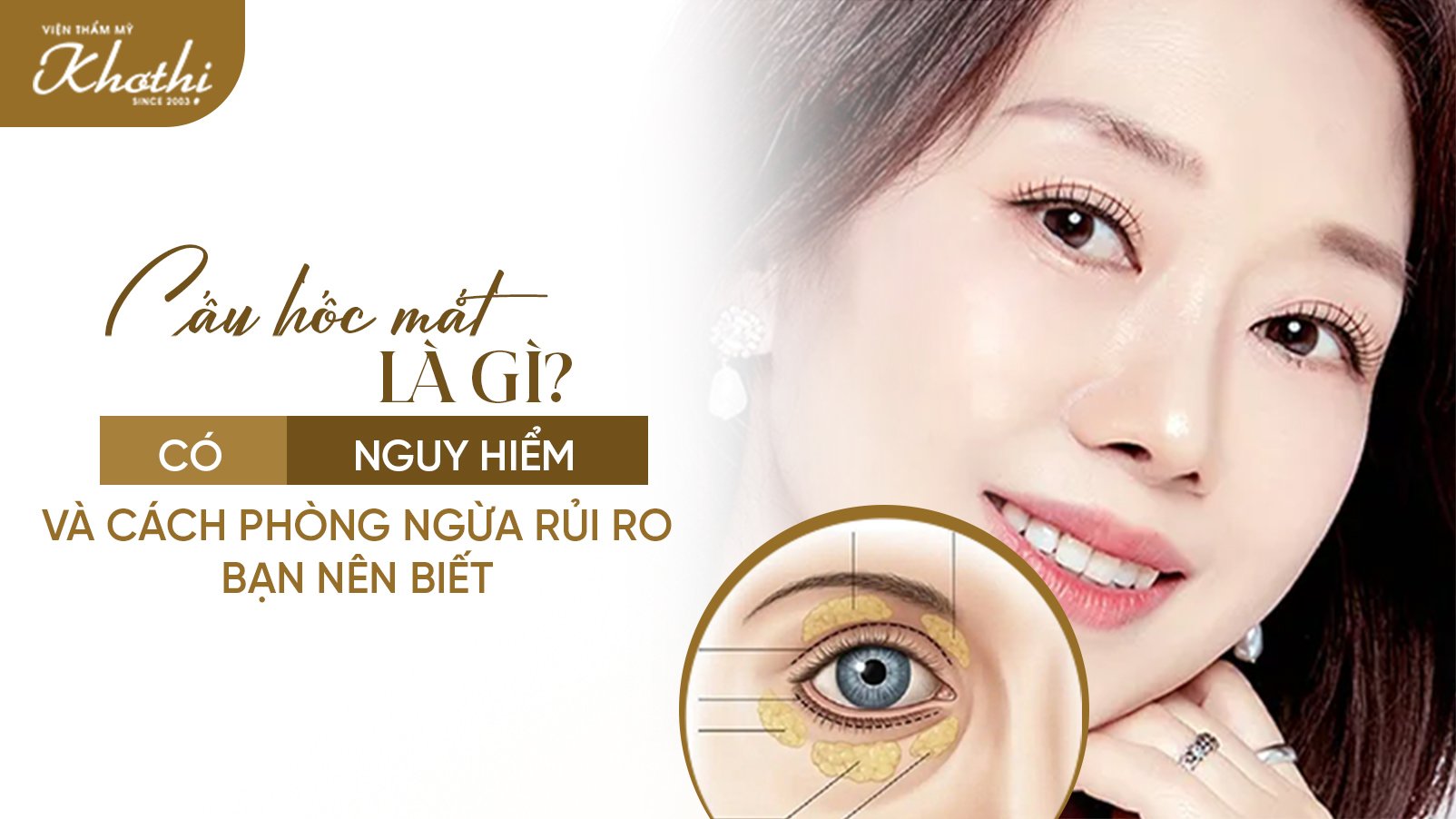 Cấy mỡ hốc mắt là gì? Có nguy hiểm không và cách phòng ngừa rủi ro bạn nên biết