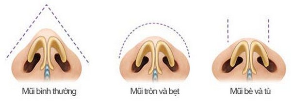Chỉnh hình thu nhỏ đầu mũi