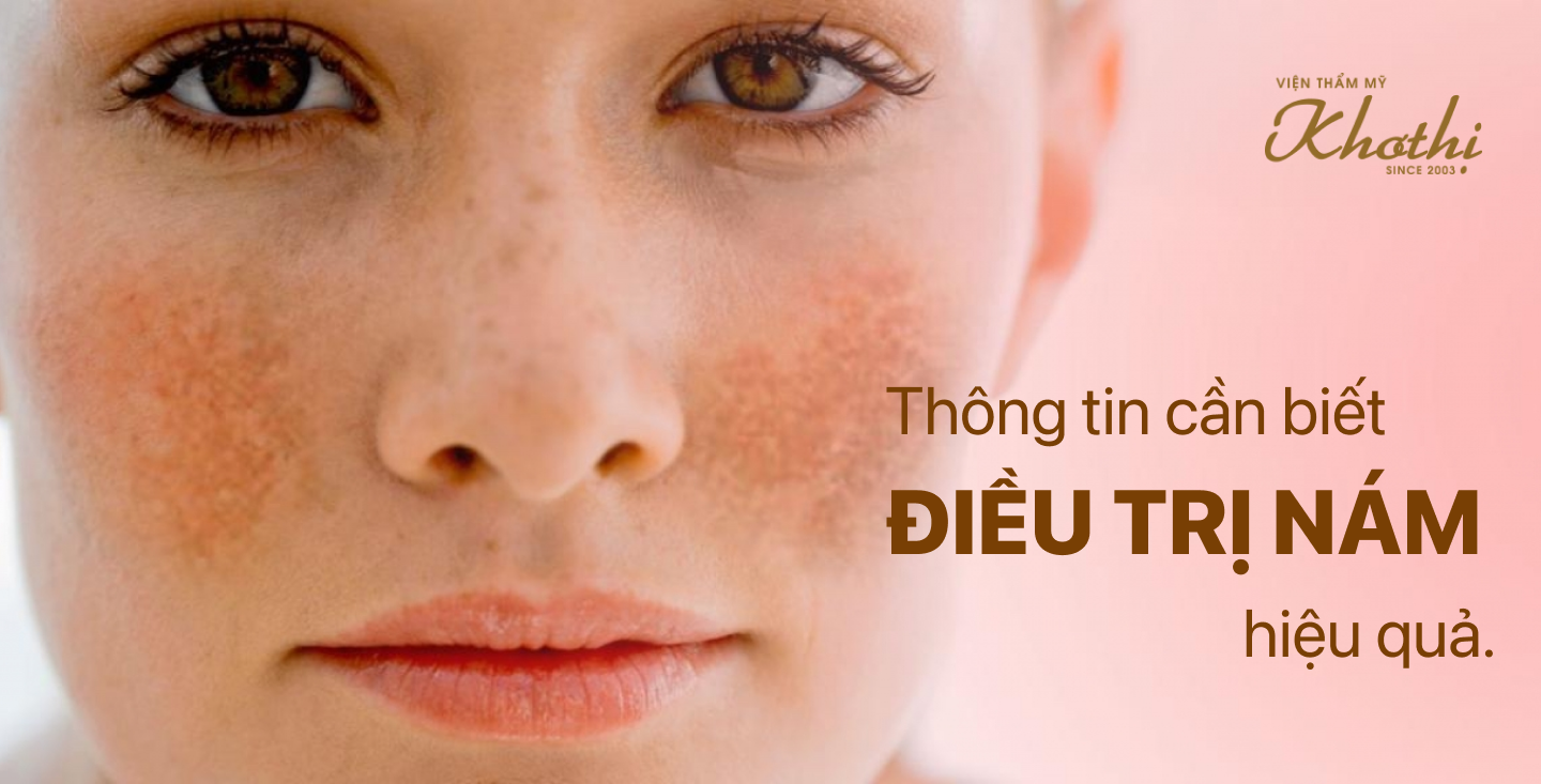 Tổng hợp toàn bộ những kiến thức điều trị nám bạn cần biết