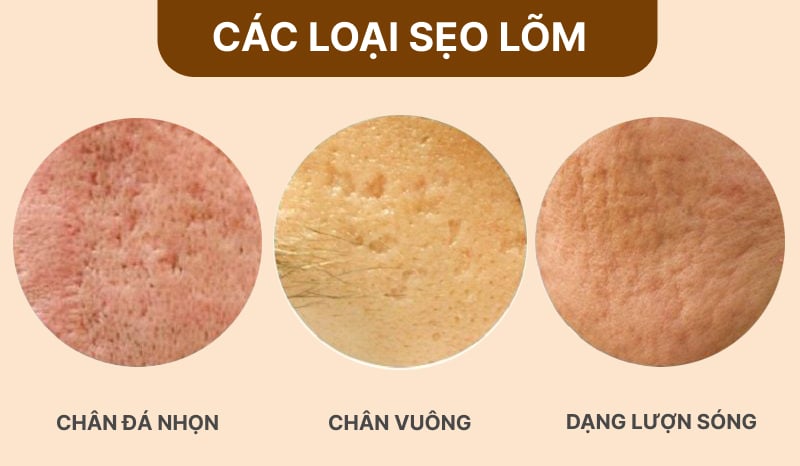 Top phương pháp trị sẹo lõm tốt nhất hiện nay