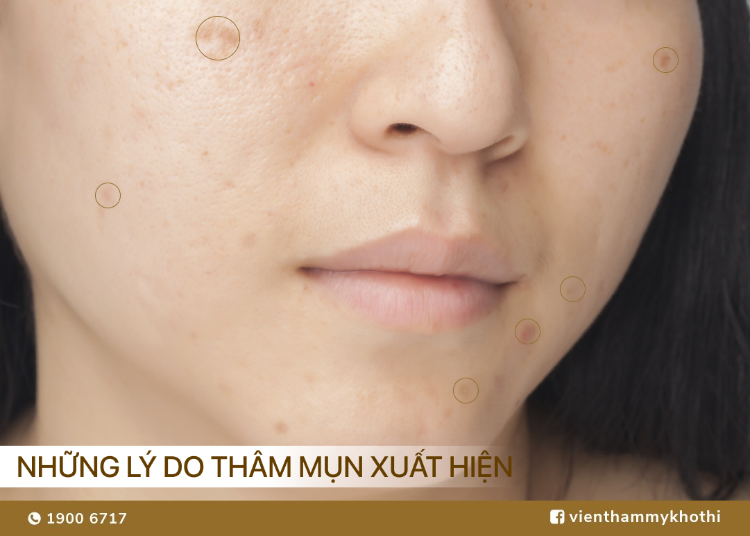 Thâm mụn và phương pháp điều trị thâm mụn hiệu quả, an toàn