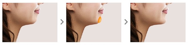 Phẫu thuật độn cằm