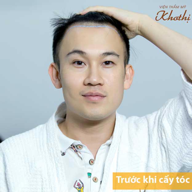 Cấy tóc tự thân giúp ca sĩ Dương Triệu Vũ thoát khỏi hói đầu, phục hồi mái tóc dày, khỏe