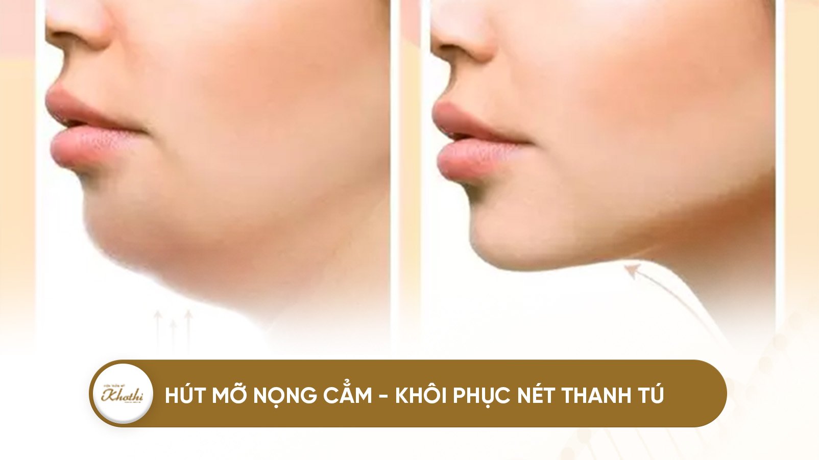 Hút mỡ vùng cằm