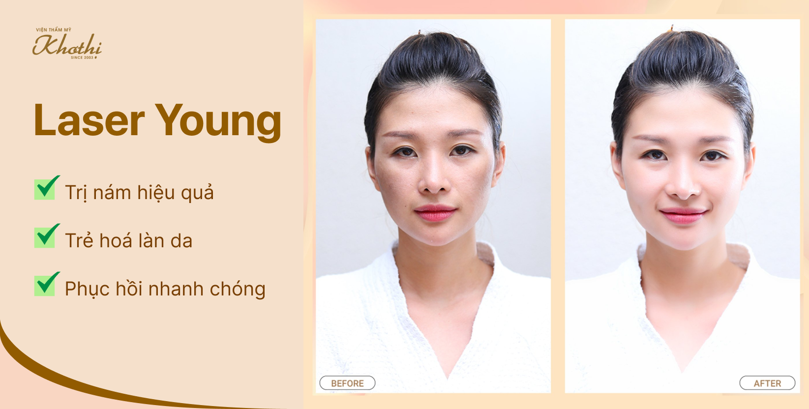 Điều trị nám Laser Young – Bước tiến của công nghệ laser
