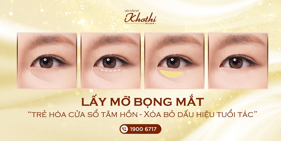 Phẫu thuật lấy lấy bọng mỡ mi dưới và thừa da mi dưới
