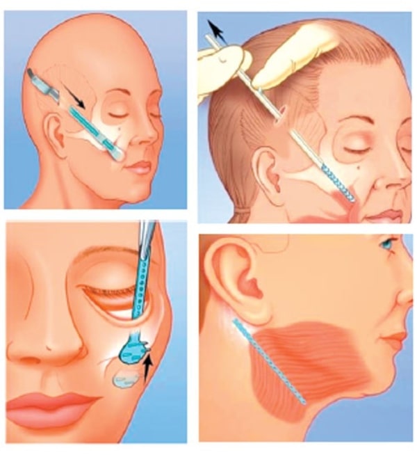 Lấy lại tuổi thanh xuân với kỹ thuật nâng cơ mặt nội soi