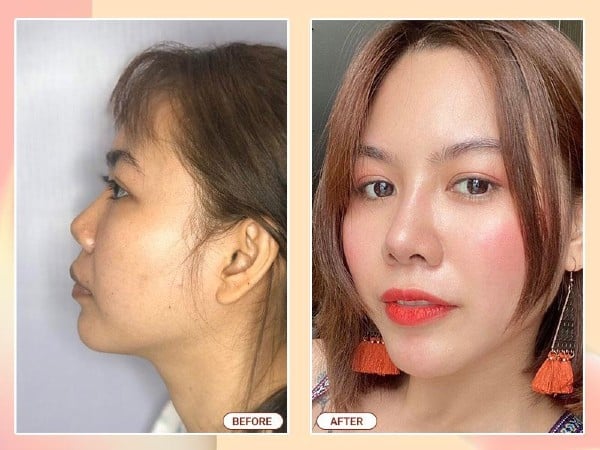 Phẫu thuật nâng mũi bằng vật liệu đôn nhân tạo