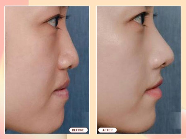 Phẫu thuật nâng mũi bằng vật liệu đôn nhân tạo kết hợp sụn tự thân