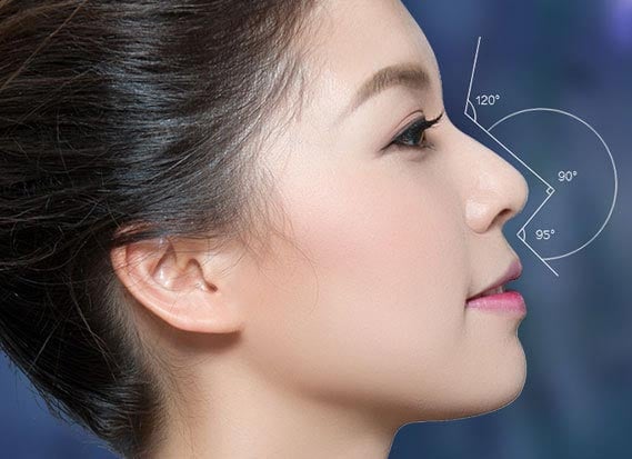 Phẫu thuật nâng mũi bằng sụn tự thân (trừ sụn sườn)