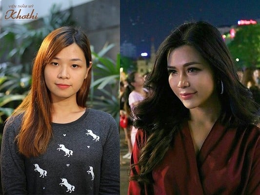 So sánh ưu nhược điểm của thẩm mỹ phẫu thuật & không phẫu thuật