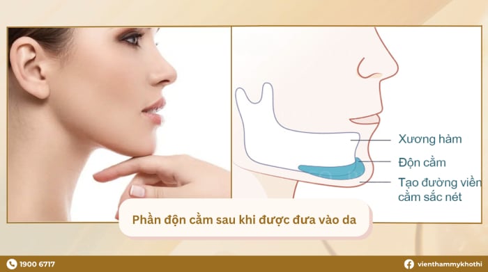 Độn cằm rồi có tiêm filler được không? 06 lưu ý quan trọng
