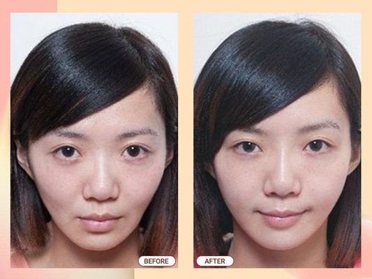 Phẫu thuật nâng độn các vật liệu sinh học điều trị má hóp