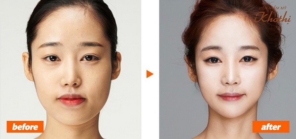 Phẫu thuật thu gọn môi dày giá bao nhiêu?