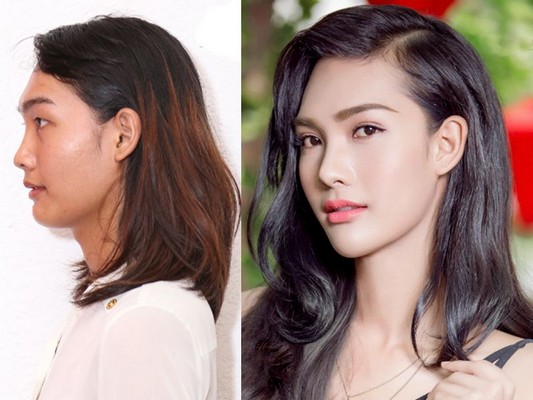 Phẫu thuật thẩm mỹ – Câu chuyện phổ biến trong xã hội hiện đại