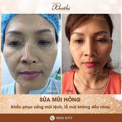 Phẫu thuật chỉnh sửa các biến chứng sau mổ nâng mũi
