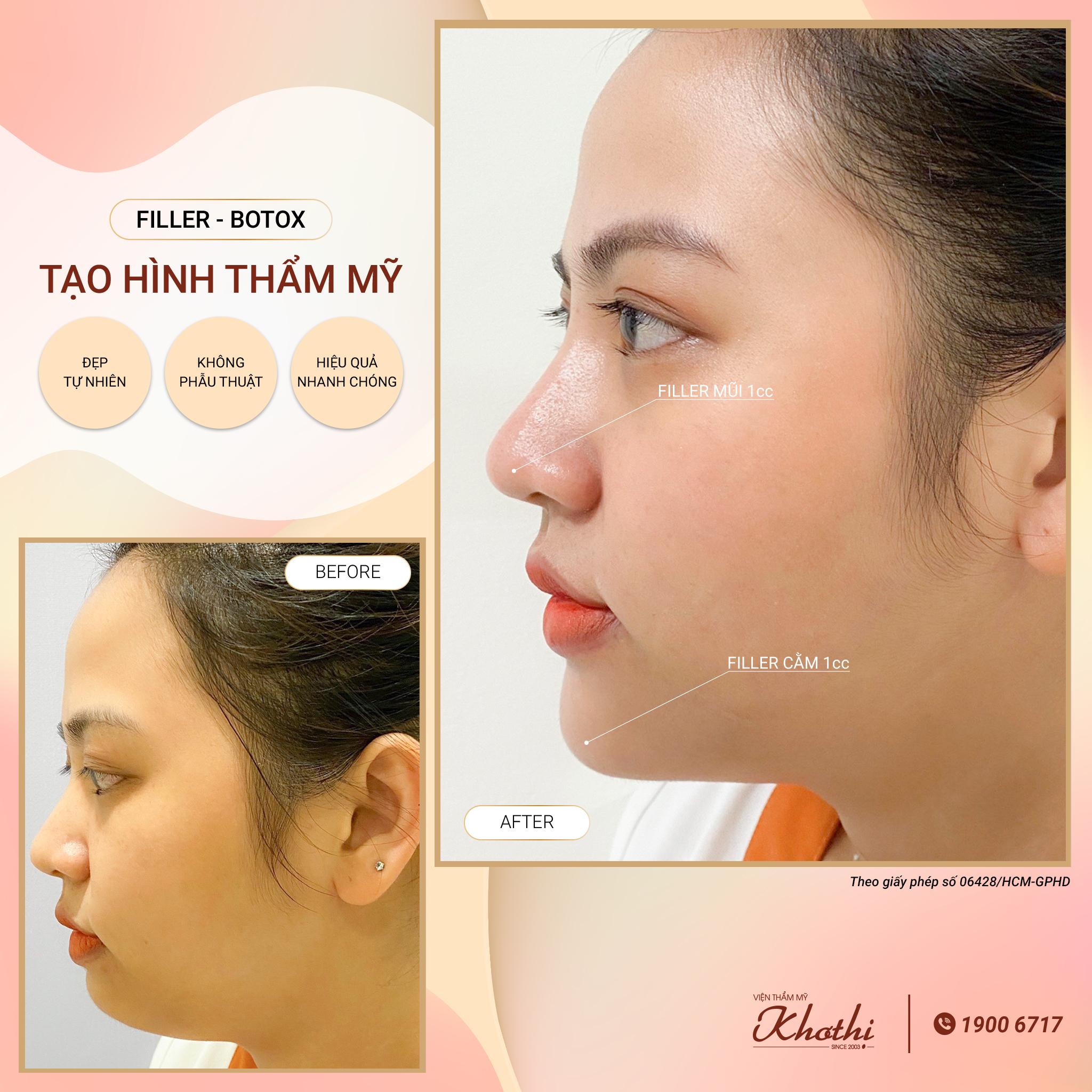 Tiêm filler nâng mũi – Đẹp tự nhiên – Không phẫu thuật