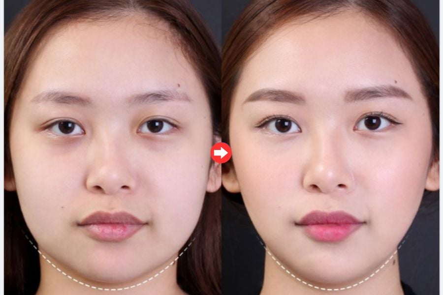 Tiêm thon gọn Khơ Thị mang lại hiệu quả thon gọn hàm nhanh chóng chỉ sau 15 phút