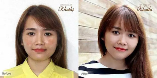Quy trình trẻ hóa da theo tiêu chuẩn y khoa của Bộ y tế sẽ giúp bạn có được làn da săn chắc