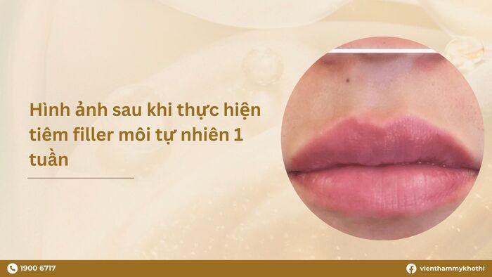 1 tuần sau khi tiêm, filler đã dần ổn định và tình trạng sưng viêm cũng bắt đầu thuyên giảm và chấm dứt