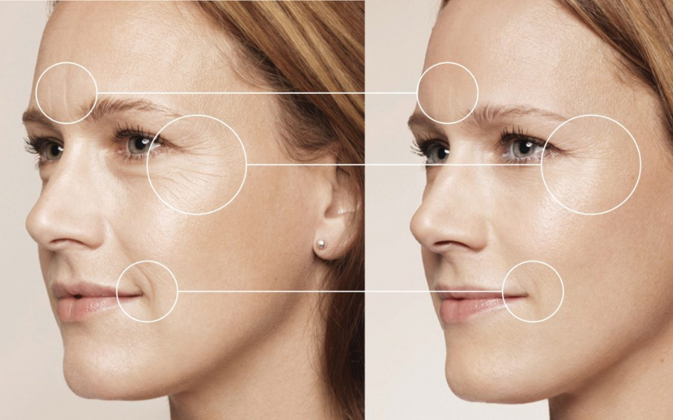 hiệu quả của elastin matrix 8d và tiêm botox