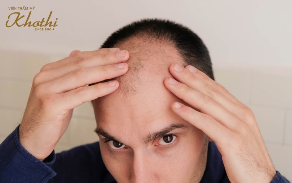 ai nên cấy tóc tự thân