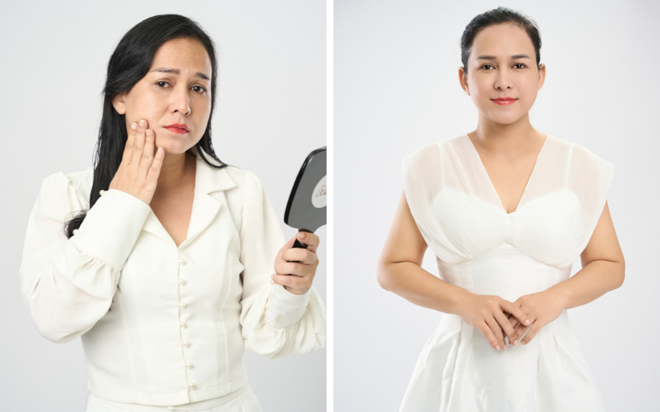 căng chỉ collagen bao lâu thì hết sưng