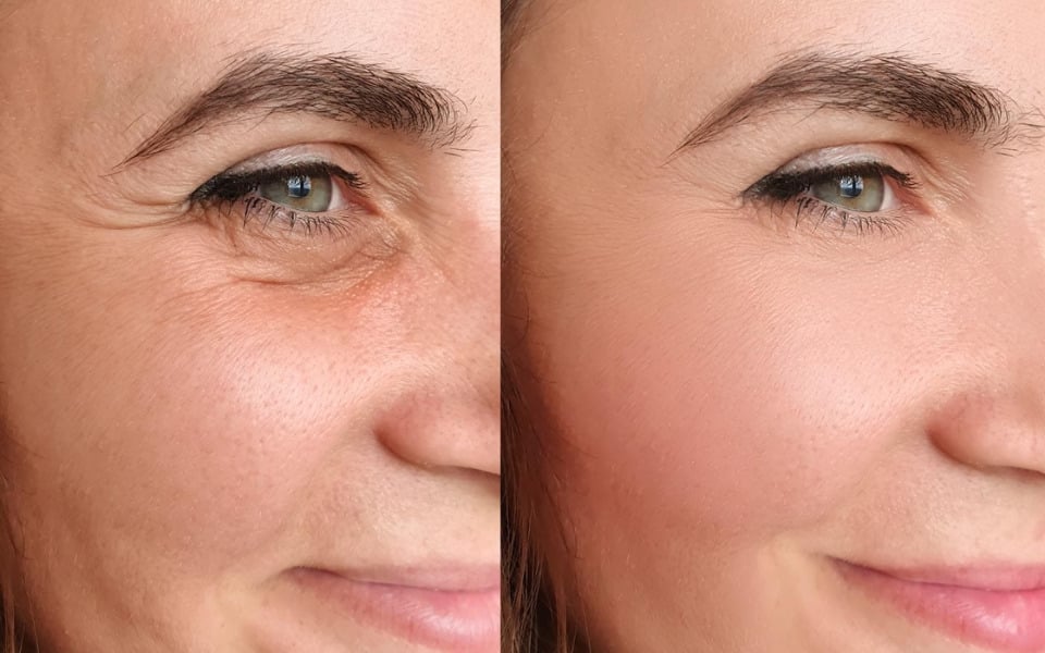 so sánh elastin matrix 8d và thermage flx