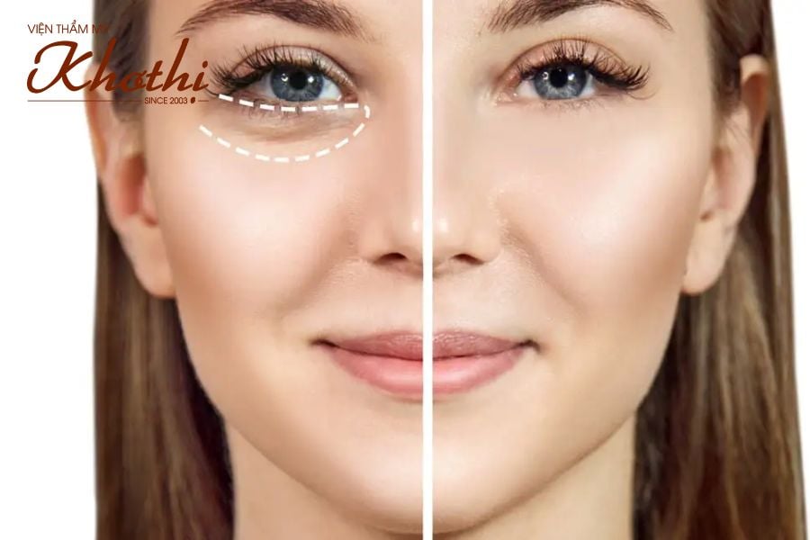 Bảng giá tiêm tan thâm quầng mắt Khơ Thị