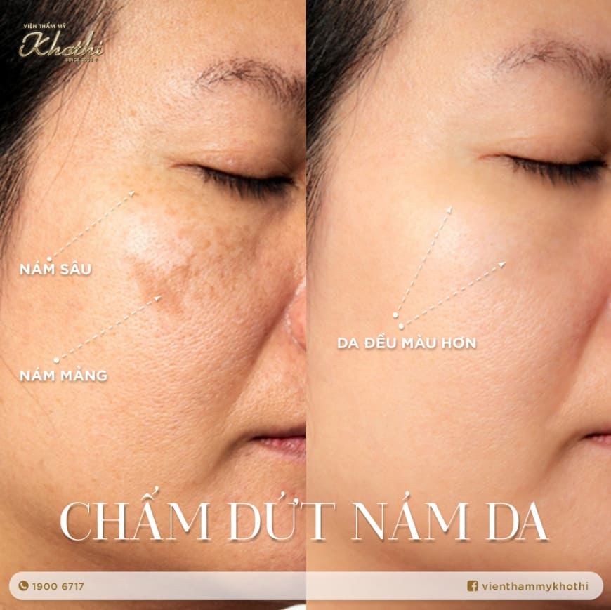 bảng giá thẩm mỹ viện Khơ Thị