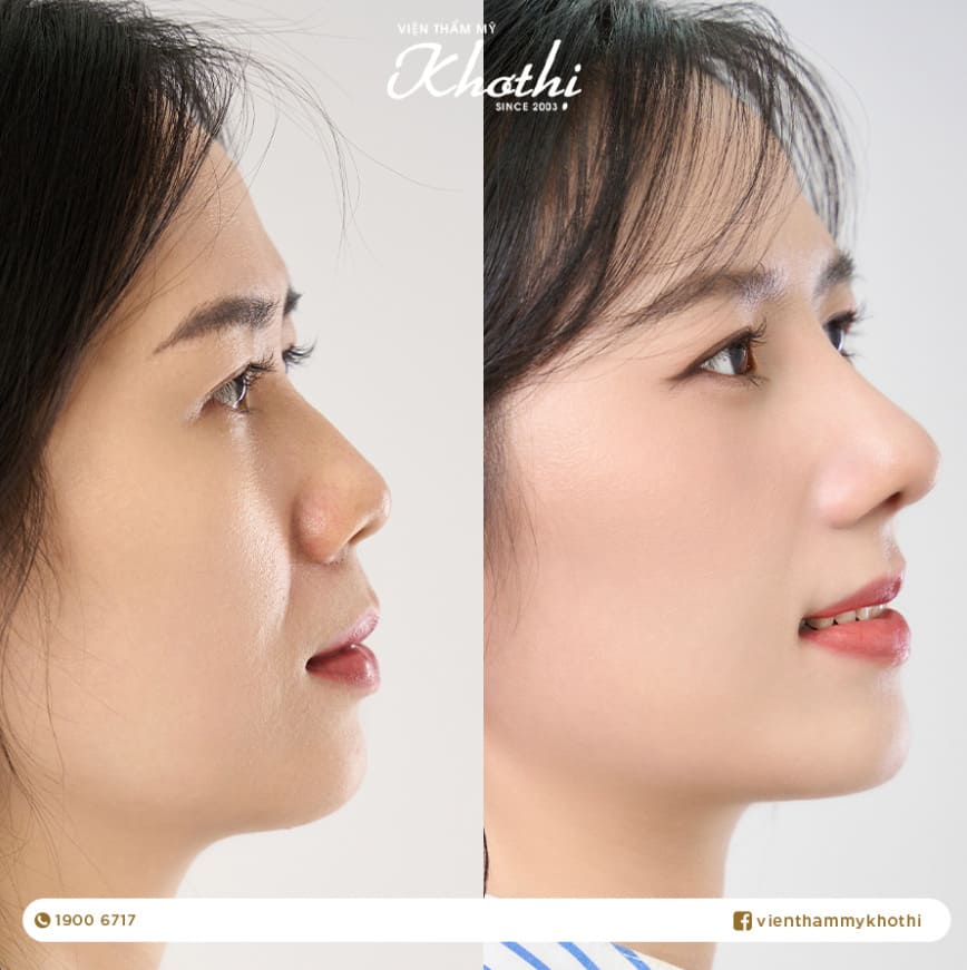 Phẫu thuật thẩm mỹ mũi Khơ Thị