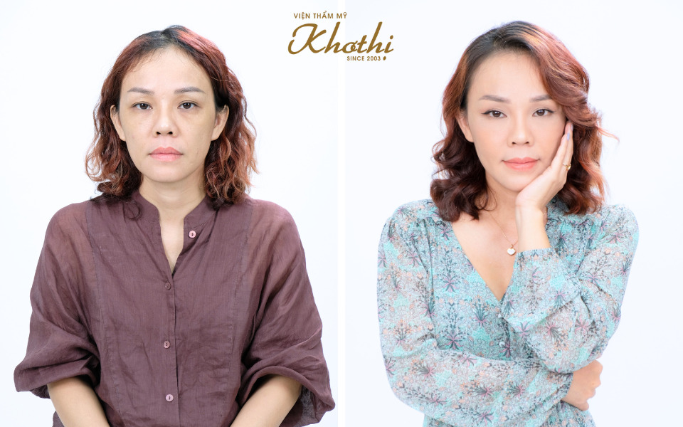 before after elastin 8d