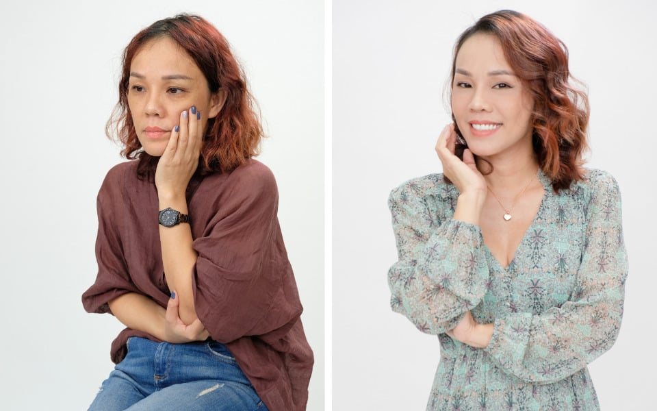 before and after elastin matrix 8d