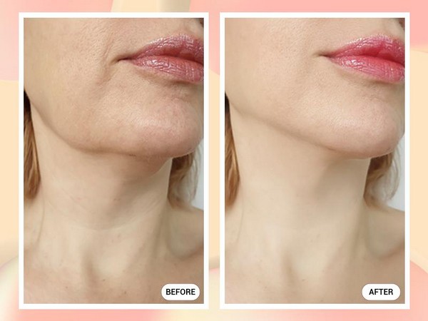 trước và sau khi phục hồi cằm hỏng do thẩm mỹ tại cơ sở thiếu uy tín