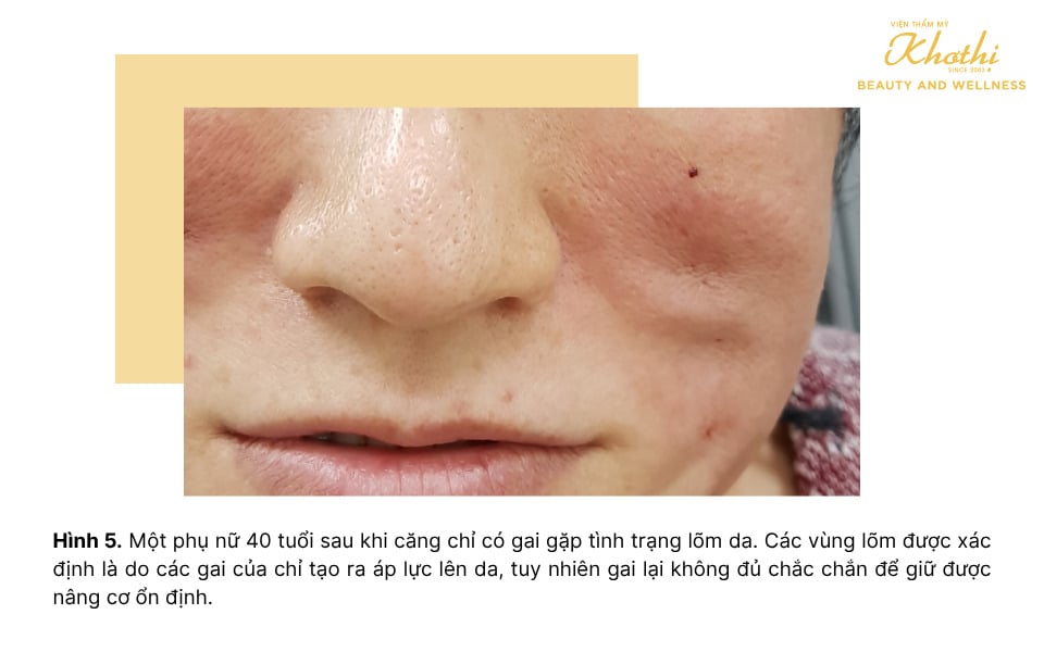 biến chứng căng chỉ