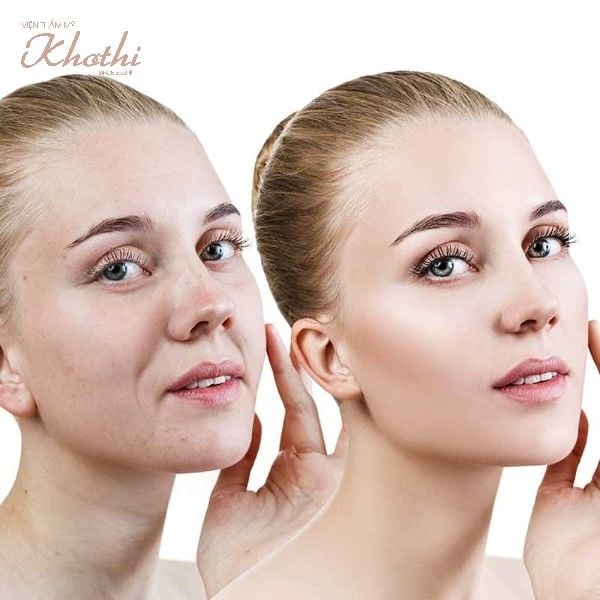 Các phương pháp nâng cơ mặt trẻ hóa da