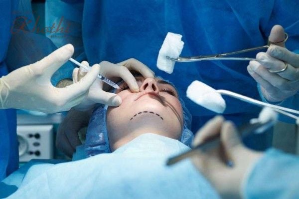 Nâng cơ mặt là gì và cách nâng cơ mặt