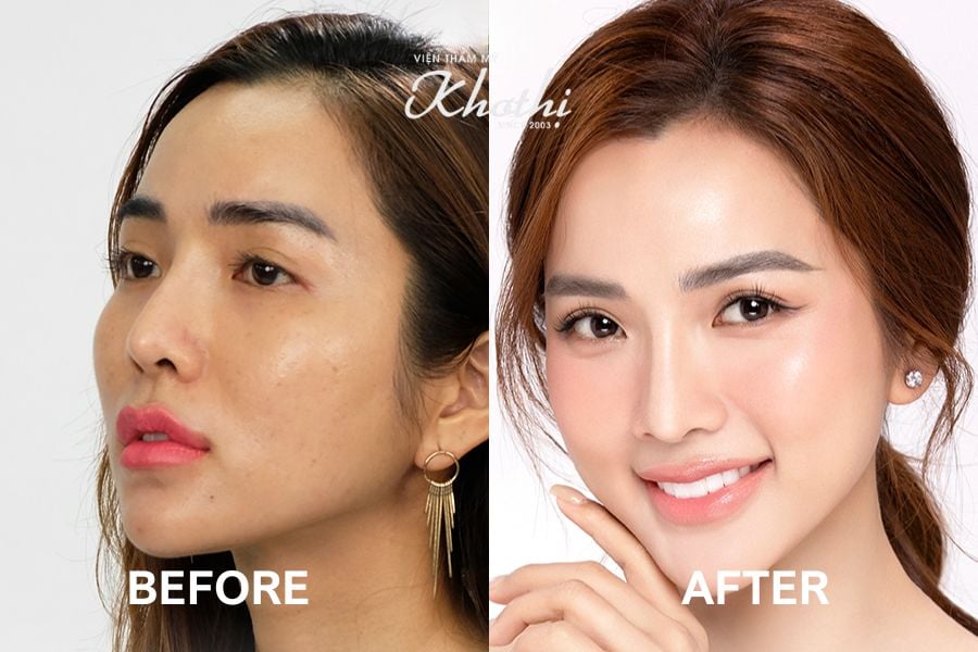 tiêm 4 điểm với Shimmer4 căng bóng da tại Khơ Thị