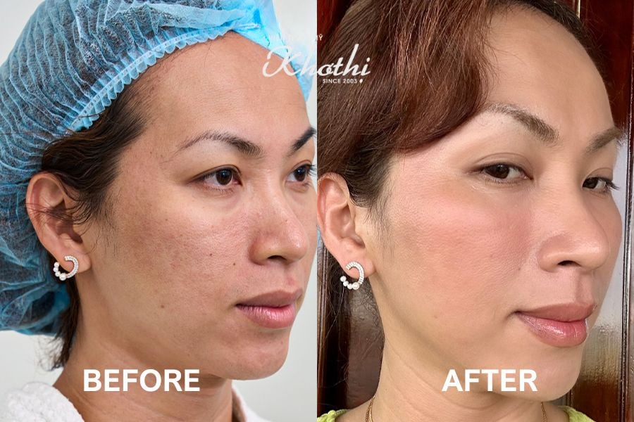 tiêm 4 điểm với Shimmer4 căng bóng da tại Khơ Thị